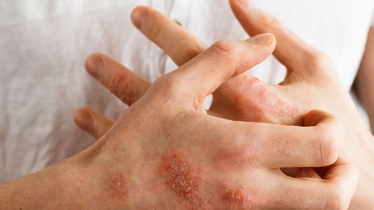 Tổ đỉa dưới da: Nguyên nhân và cách điều trị - Nhà thuốc FPT Long Châu