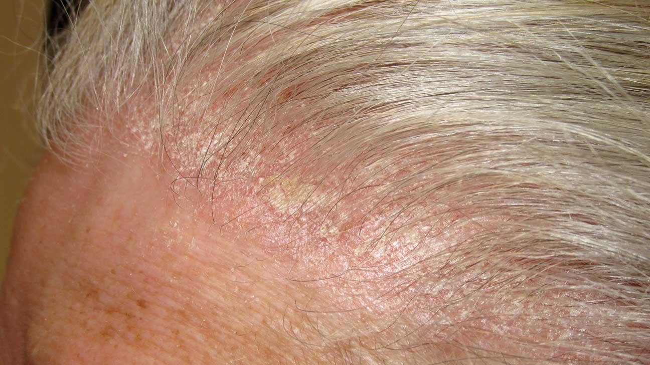 Vẩy Nến Da Đầu Ở Người Già : Dấu Hiệu Và Cách Điều Trị - iCare Pharma