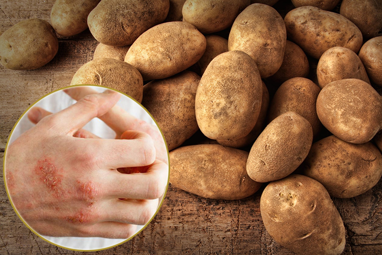 Bí quyết chữa bệnh chàm bằng khoai tây hiệu quả