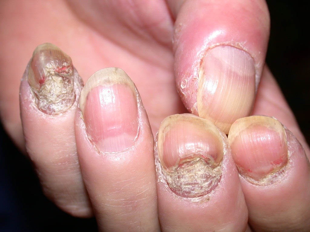Bệnh vẩy nến ở móng tay, nguyên nhân bệnh là gì