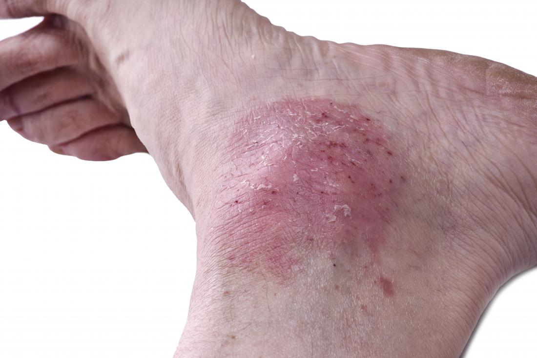 Vẩy nến ở chân là bệnh gì? Điều trị ra sao cho hiệu quả? | Báo Dân trí