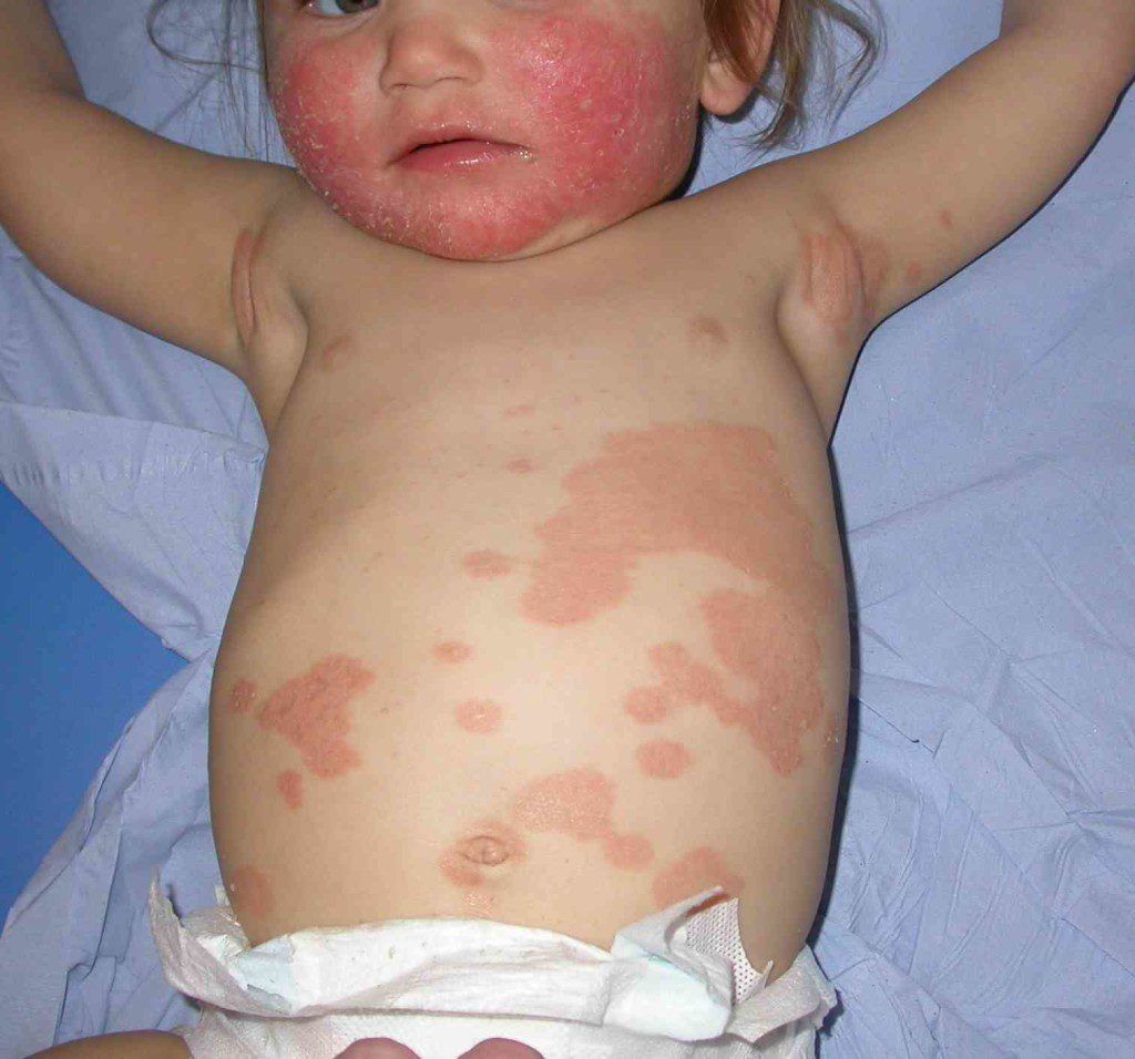 Bệnh vảy phấn trắng ở trẻ sơ sinh: Dấu hiệu và cách điều trị
