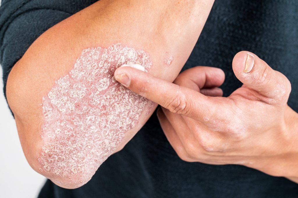 Dùng thuốc gì trị bệnh vẩy nến hiệu quả với làn da?